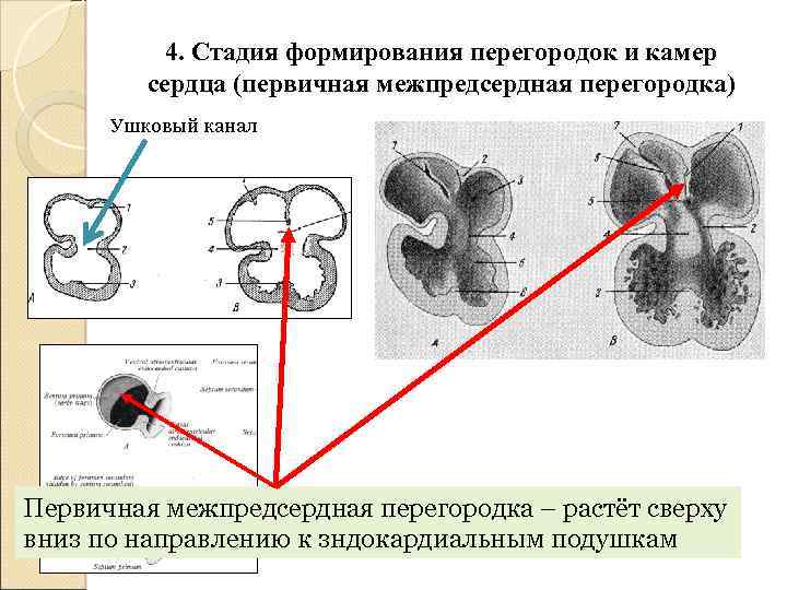 4. Стадия формирования перегородок и камер сердца (первичная межпредсердная перегородка) Ушковый канал Первичная межпредсердная
