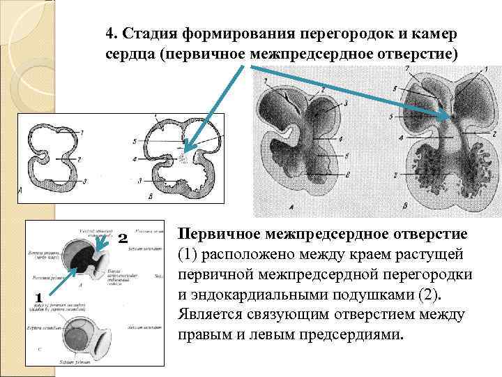 Аневризма межпредсердной перегородки у взрослых прогноз