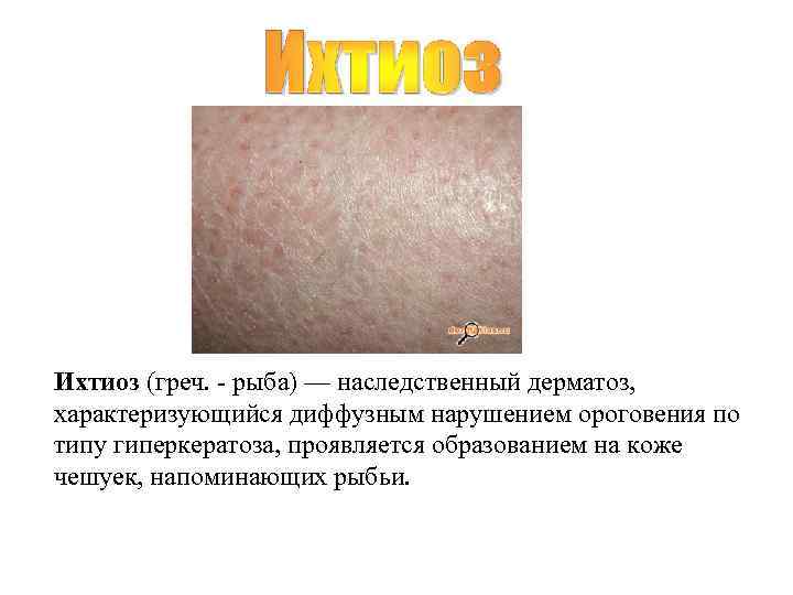 Ихтиоз (греч. - рыба) — наследственный дерматоз,  характеризующийся диффузным нарушением ороговения по типу