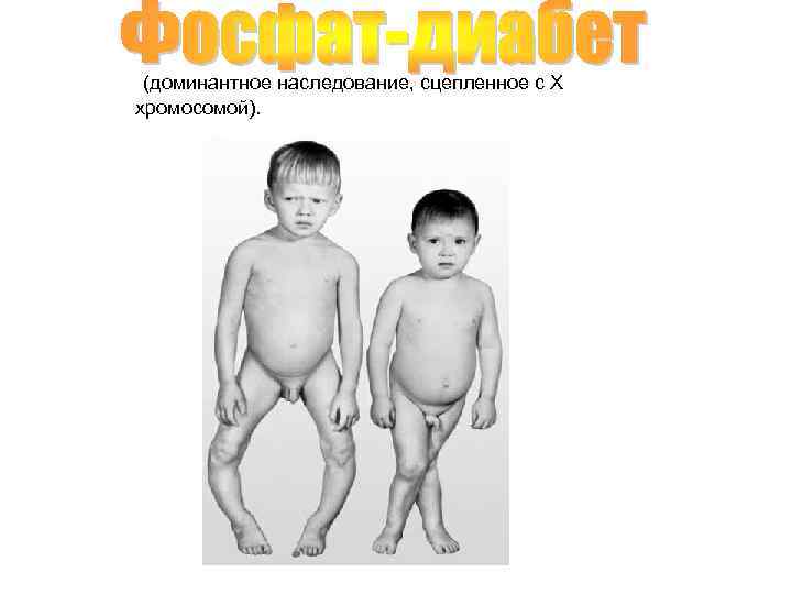  (доминантное наследование, сцепленное с Х хромосомой). 