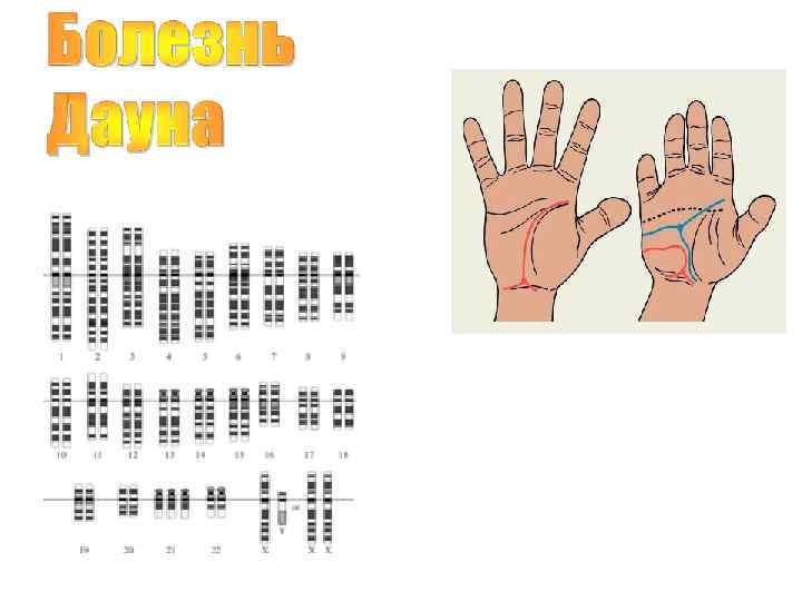 Кариотип больного 