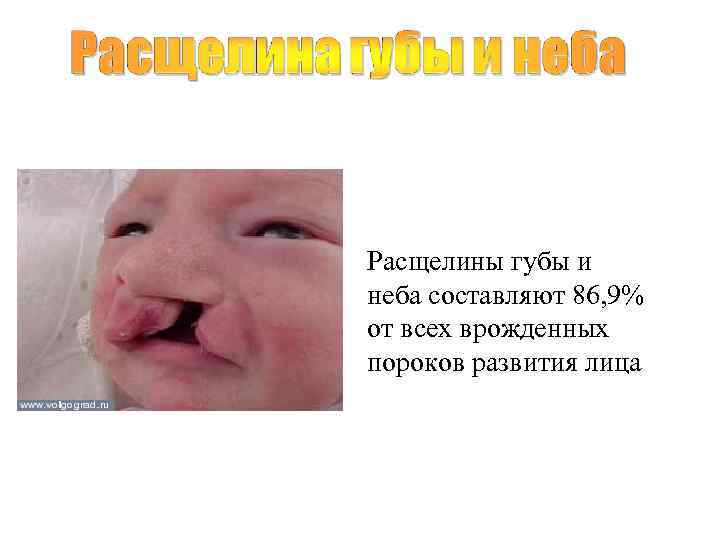 Расщелины губы и неба составляют 86, 9% от всех врожденных пороков развития лица 