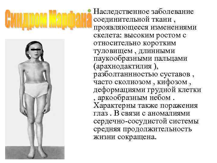  Наследственное заболевание  соединительной ткани , проявляющееся изменениями  скелета: высоким ростом с