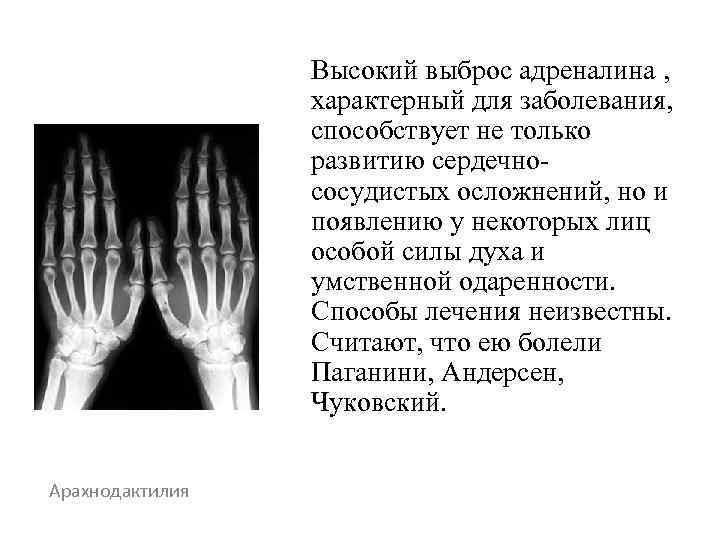    Высокий выброс адреналина ,    характерный для заболевания, 