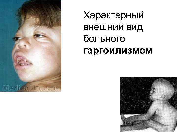 Характерный внешний вид больного гаргоилизмом 