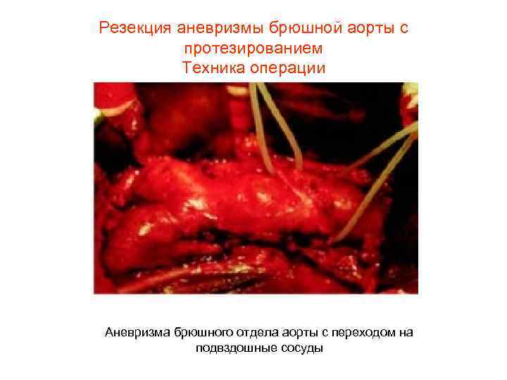 Резекция аневризмы брюшной аорты с протезированием Техника операции Аневризма брюшного отдела аорты с переходом