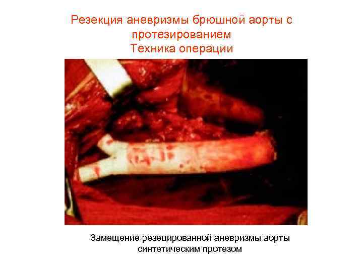 Резекция аневризмы брюшной аорты с протезированием Техника операции Замещение резецированной аневризмы аорты синтетическим протезом