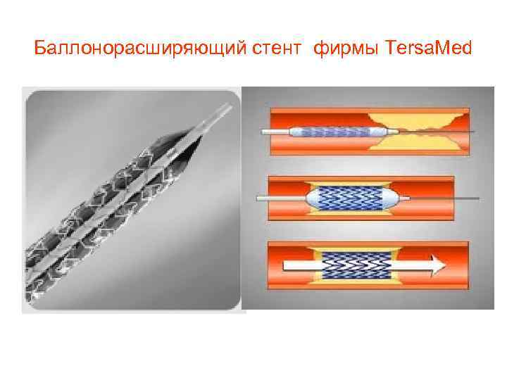 Баллонорасширяющий стент фирмы Tersa. Med 