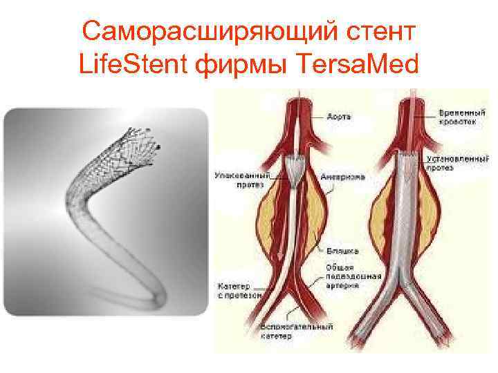 Саморасширяющий стент Life. Stent фирмы Tersa. Med 