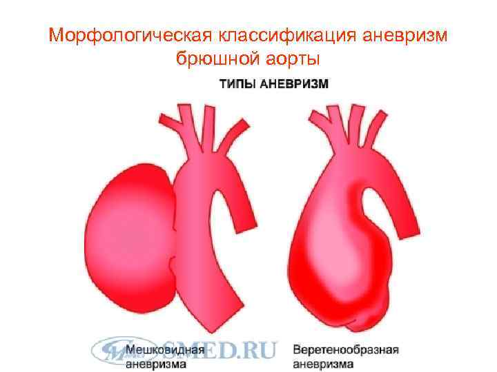 Аневризма отдела аорты. Классификация аневризм брюшного отдела аорты. Классификация аневризм аорты. Классификация аневризм брюшной аорты. Классификация аневризм восходящего отдела аорты.