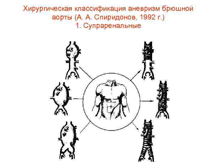 Хирургическая классификация аневризм брюшной аорты (А. А. Спиридонов, 1992 г. ) 1. Супраренальные 
