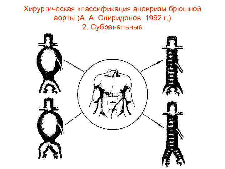 Склероз брюшной аорты