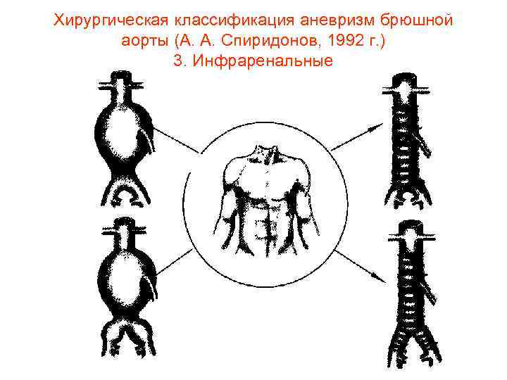 Хирургическая классификация аневризм брюшной аорты (А. А. Спиридонов, 1992 г. ) 3. Инфраренальные 