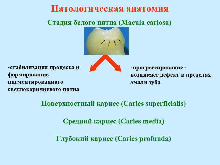 Патологическая анатомия Стадия белого пятна (Macula cariosa) стабилизация процесса и формирование пигментированного светлокоричневого пятна