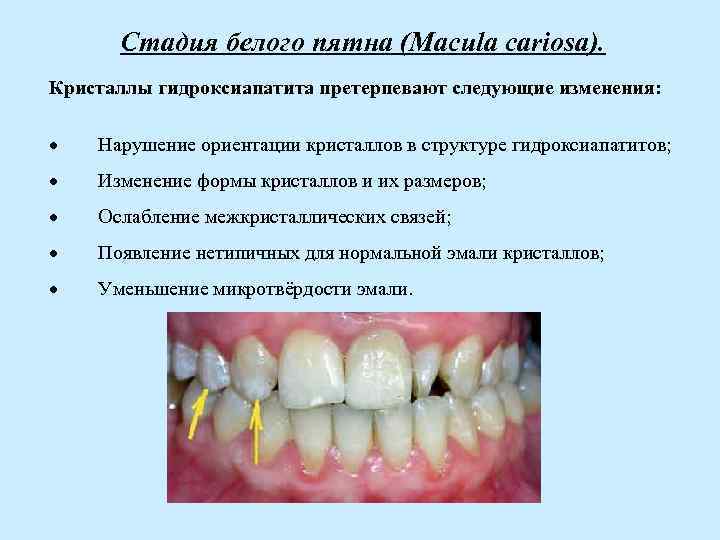 Стадия белого пятна (Macula cariosa). Кристаллы гидроксиапатита претерпевают следующие изменения: · Нарушение ориентации кристаллов