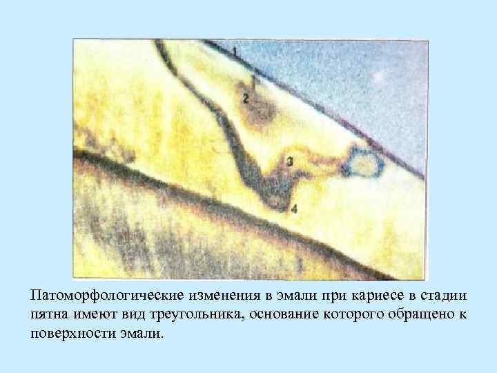 Патоморфологические изменения в эмали при кариесе в стадии пятна имеют вид треугольника, основание которого