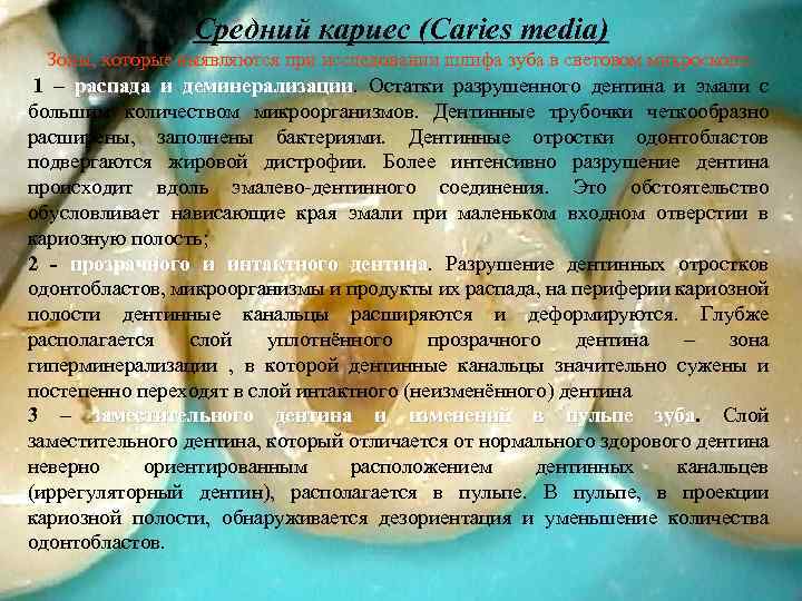 Средний кариес (Caries media) Зоны, которые выявляются при исследовании шлифа зуба в световом микроскопе: