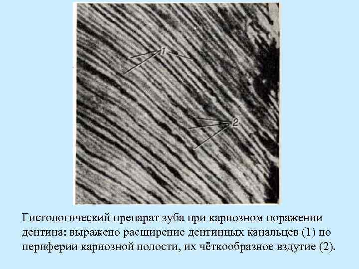 Гистологический препарат зуба при кариозном поражении дентина: выражено расширение дентинных канальцев (1) по периферии