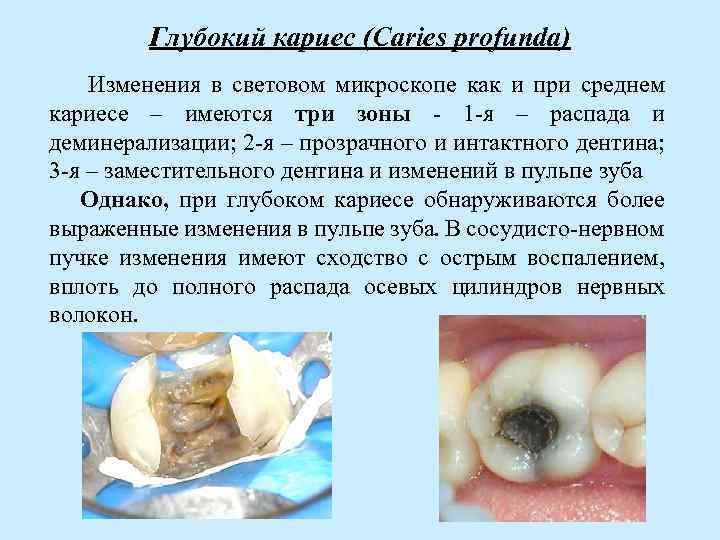Глубокий кариес (Caries profunda) Изменения в световом микроскопе как и при среднем кариесе –