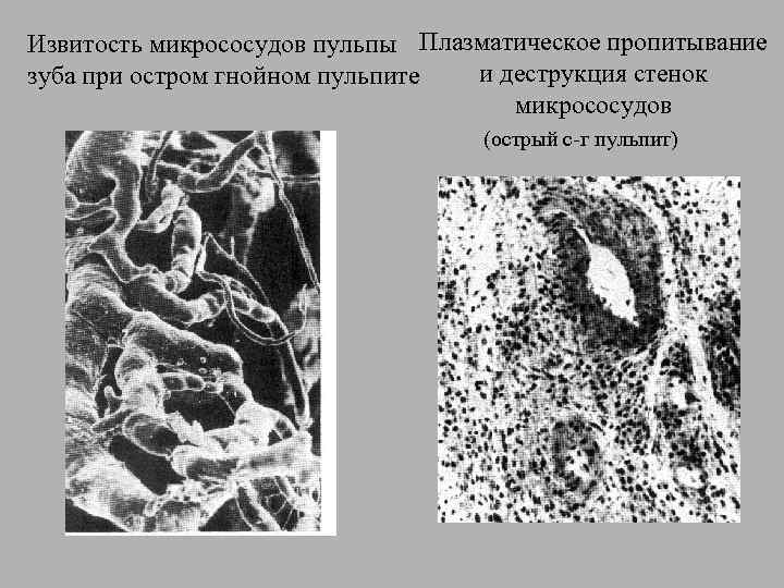 Извитость микрососудов пульпы Плазматическое пропитывание и деструкция стенок зуба при остром гнойном пульпите микрососудов