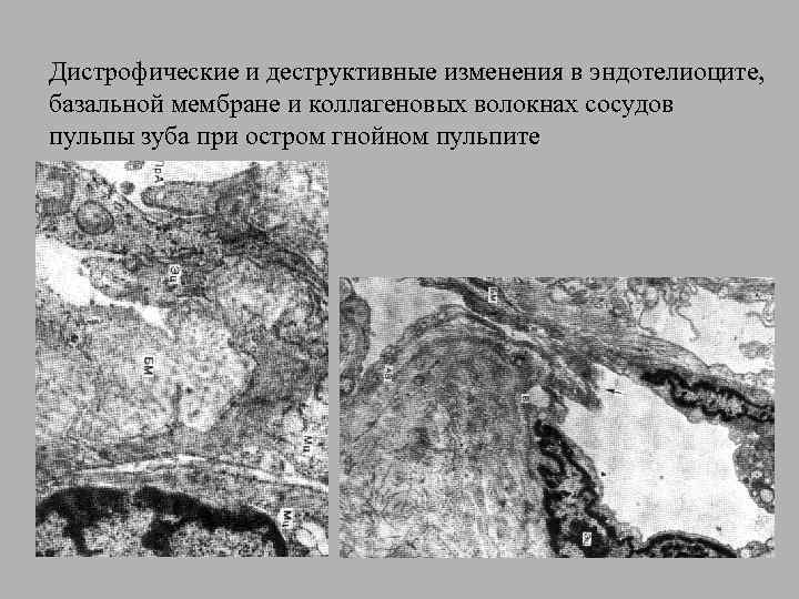 Дистрофические и деструктивные изменения в эндотелиоците, базальной мембране и коллагеновых волокнах сосудов пульпы зуба