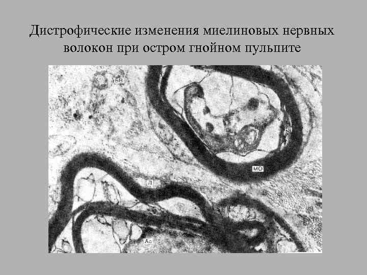 Дистрофические изменения миелиновых нервных волокон при остром гнойном пульпите 