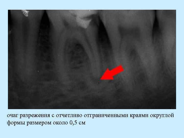 очаг разрежения с отчетливо отграниченными краями округлой формы размером около 0, 5 см 