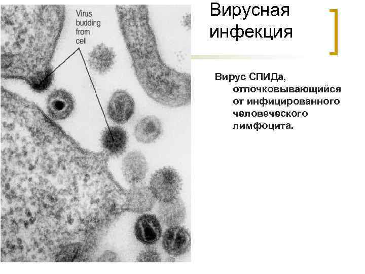Вирусная инфекция Вирус СПИДа, отпочковывающийся от инфицированного человеческого лимфоцита. 