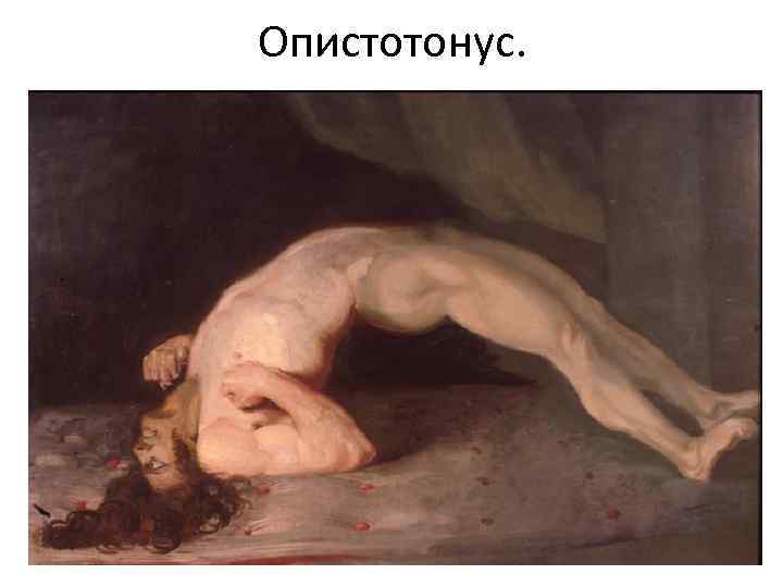 Опистотонус. 