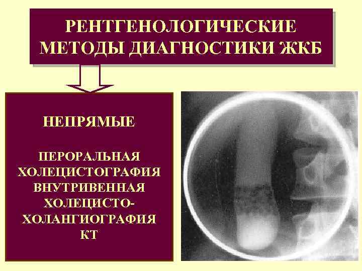 РЕНТГЕНОЛОГИЧЕСКИЕ МЕТОДЫ ДИАГНОСТИКИ ЖКБ НЕПРЯМЫЕ ПЕРОРАЛЬНАЯ ХОЛЕЦИСТОГРАФИЯ ВНУТРИВЕННАЯ ХОЛЕЦИСТОХОЛАНГИОГРАФИЯ КТ 