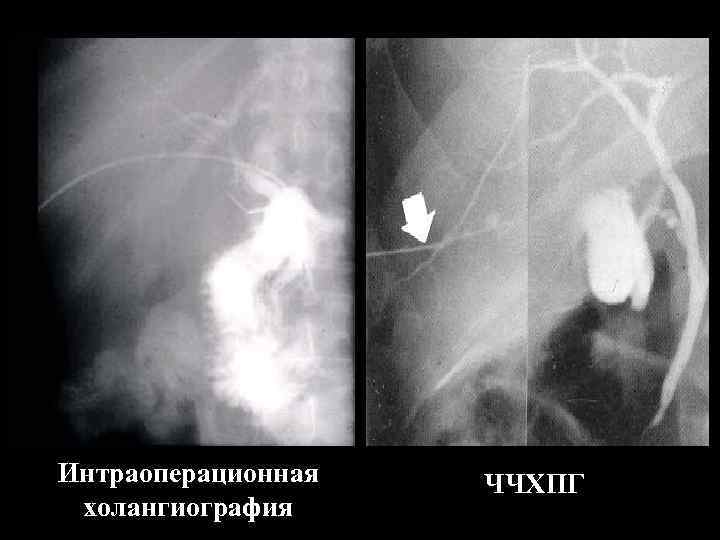Интраоперационная холангиография ЧЧХПГ 