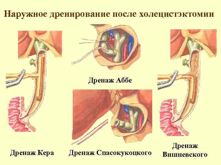 Послеоперационный период после холецистэктомии