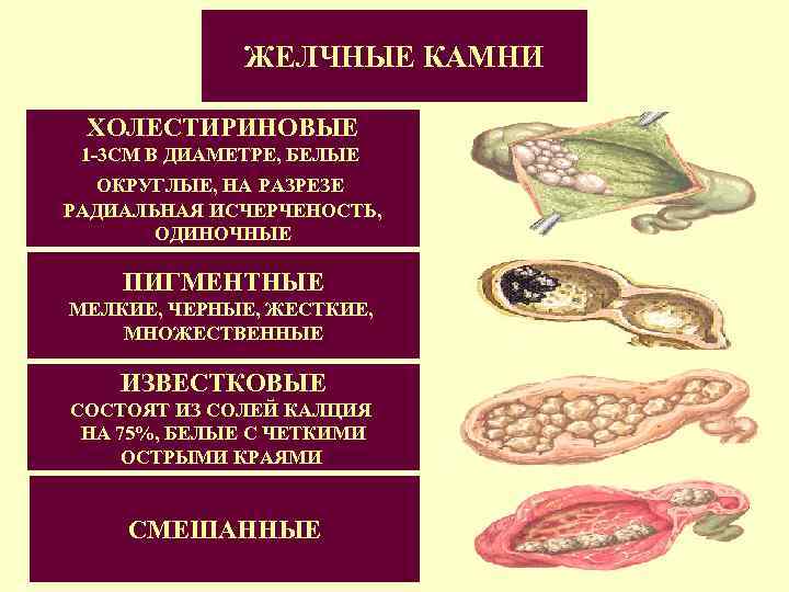 ЖЕЛЧНЫЕ КАМНИ ХОЛЕСТИРИНОВЫЕ 1 -3 СМ В ДИАМЕТРЕ, БЕЛЫЕ ОКРУГЛЫЕ, НА РАЗРЕЗЕ РАДИАЛЬНАЯ ИСЧЕРЧЕНОСТЬ,