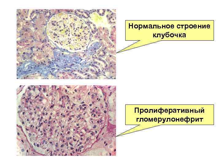 Нормальное строение клубочка Пролиферативный гломерулонефрит 