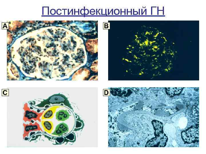 Постинфекционный ГН A B C D 