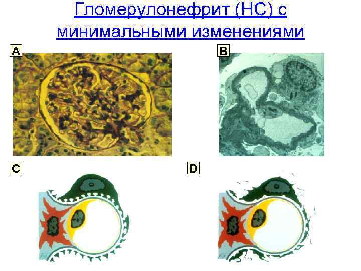 Гломерулонефрит (НС) с минимальными изменениями A C B D 