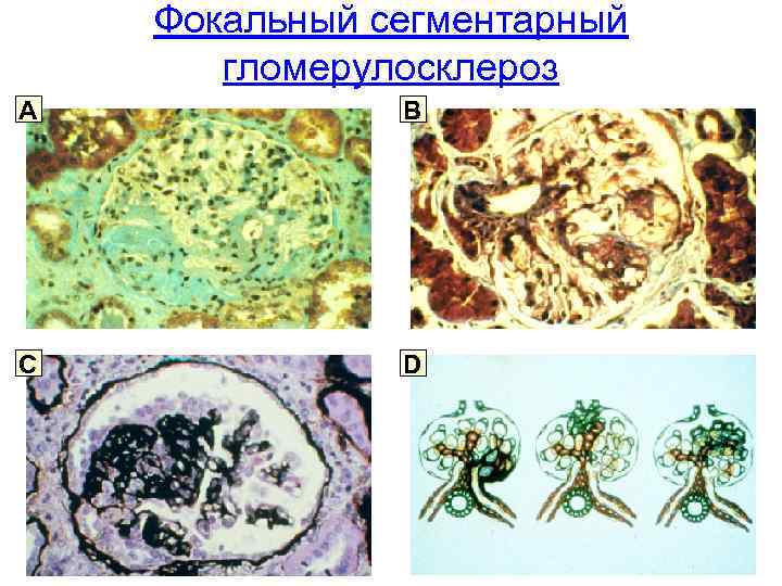 Фокальный сегментарный гломерулосклероз A B C D 