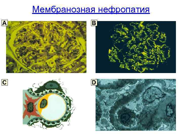 Мембранозная нефропатия A B C D 