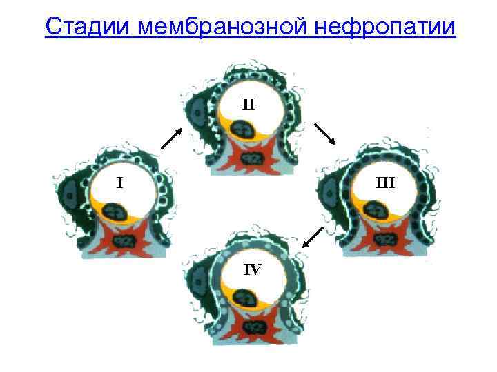 Стадии мембранозной нефропатии II I III IV 