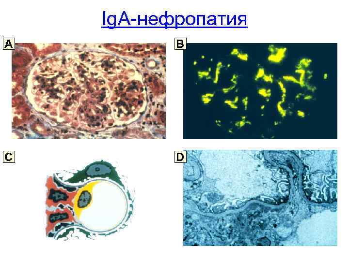 Ig. A-нефропатия A B C D 