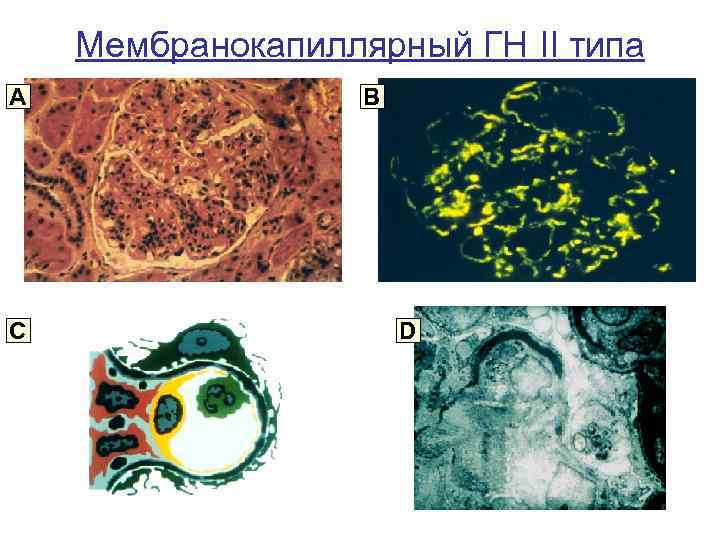 Мембранокапиллярный ГН II типа A C B D 