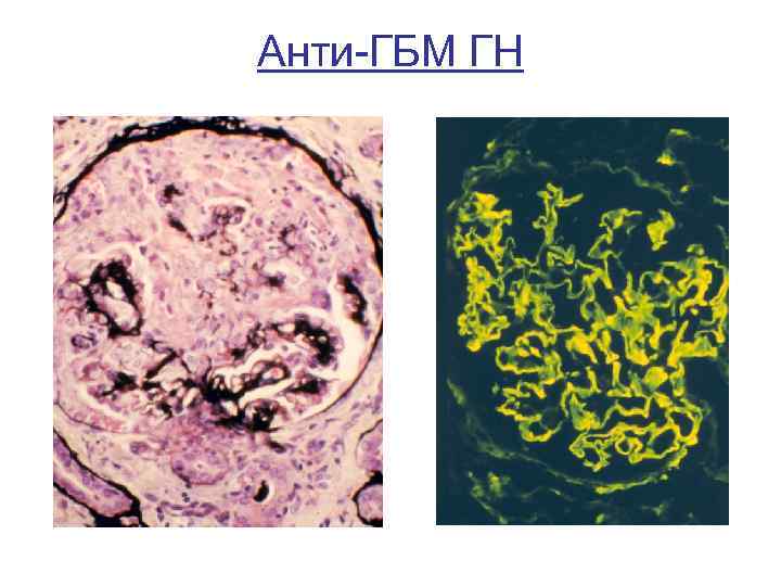 Анти-ГБМ ГН 