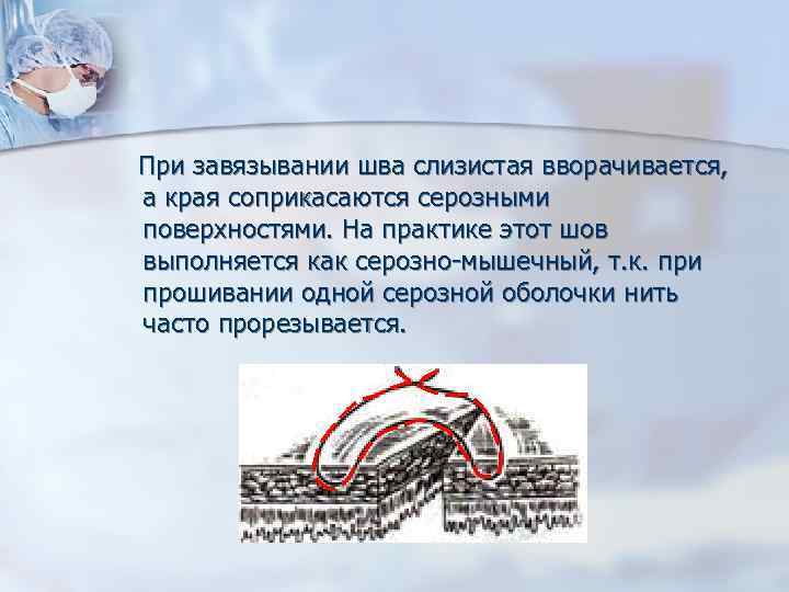  При завязывании шва слизистая вворачивается, а края соприкасаются серозными поверхностями. На практике этот