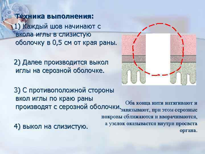 Техника выполнения: 1) Каждый шов начинают с вкола иглы в слизистую оболочку в 0,