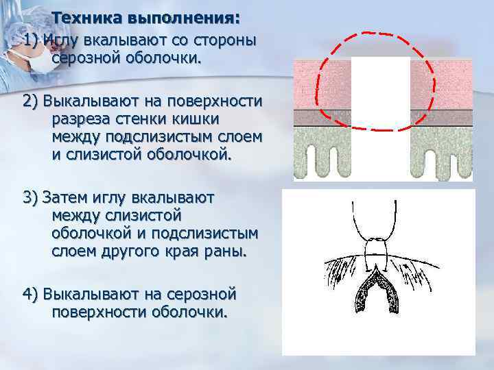 Техника выполнения: 1) Иглу вкалывают со стороны серозной оболочки. n 2) Выкалывают на поверхности