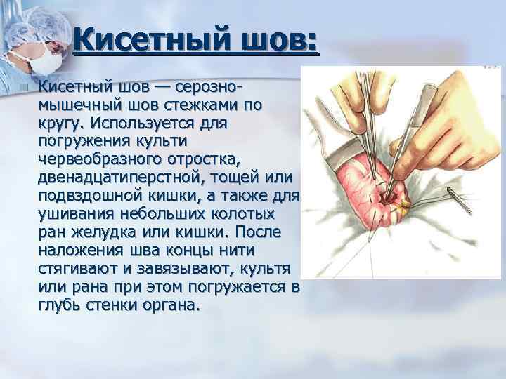 Кисетный шов: n Кисетный шов — серозно мышечный шов стежками по кругу. Используется для