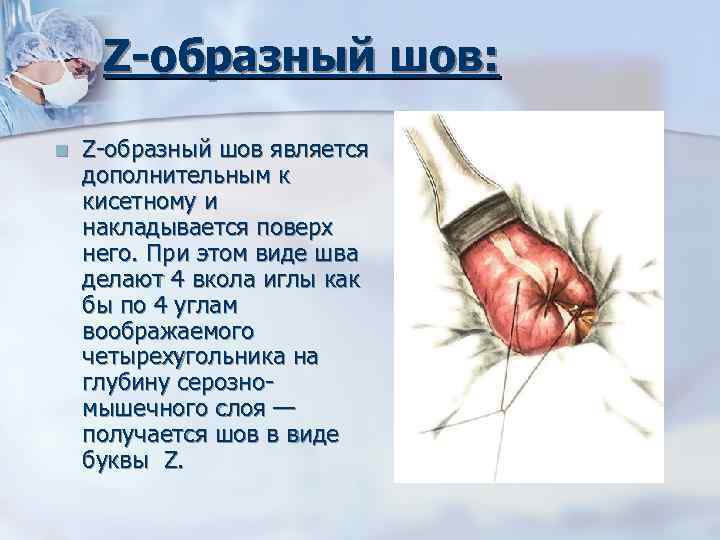 Z-образный шов: n Z образный шов является дополнительным к кисетному и накладывается поверх него.