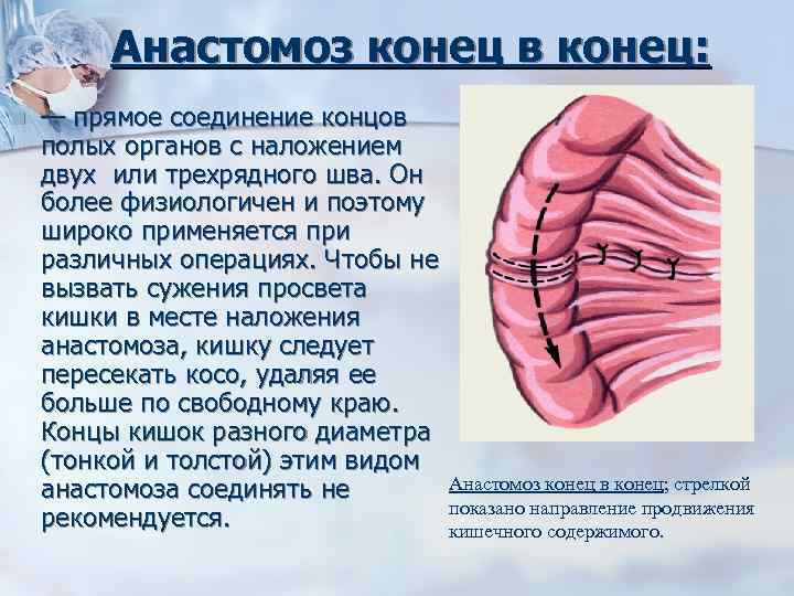 Анастомоз конец в конец: n — прямое соединение концов полых органов с наложением двух