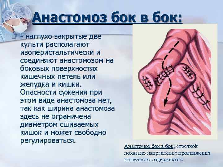 Анастомоз бок в бок: n наглухо закрытые две культи располагают изоперистальтически и соединяют анастомозом