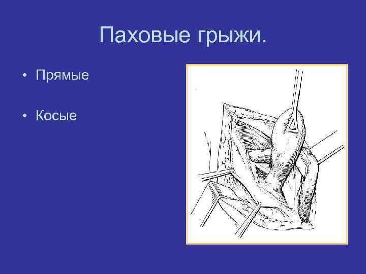 Паховые грыжи. • Прямые • Косые 